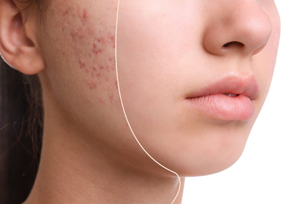 split close-up view of a woman’s cheek showing acne scars on one side and smoother skin on the other