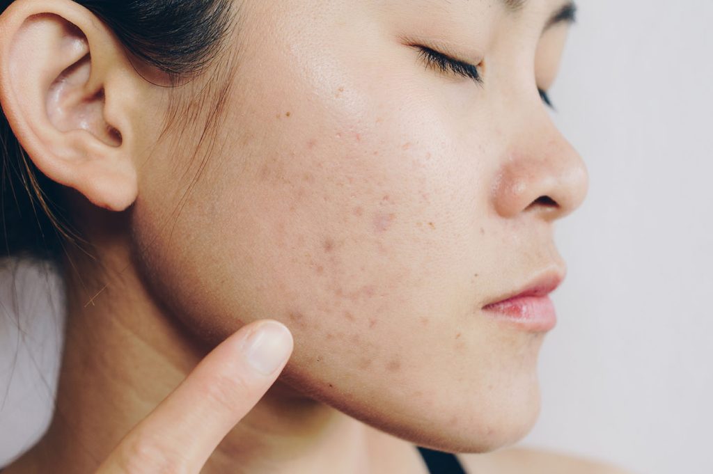 close-up of a woman’s cheek with acne scars as she points to the affected area