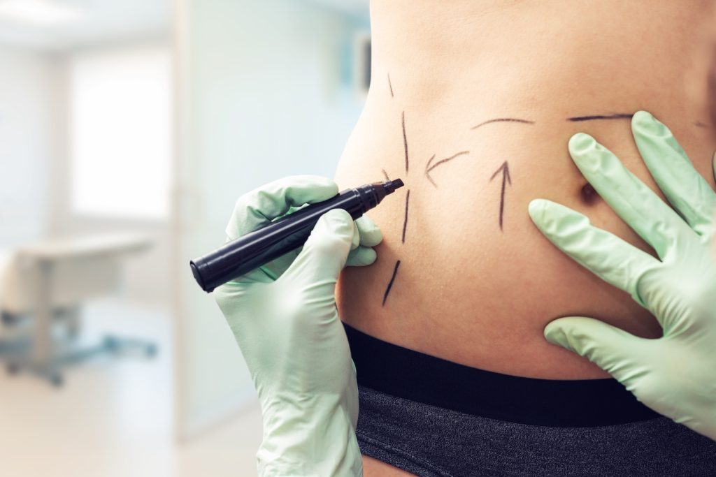 Gloved hands draw marker lines on a person’s abdomen near the navel in a clinical exam room.