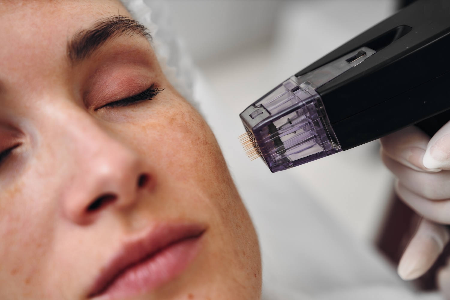 Gloved hand holds a microneedling device near a person’s cheek while the person lies down with eyes closed