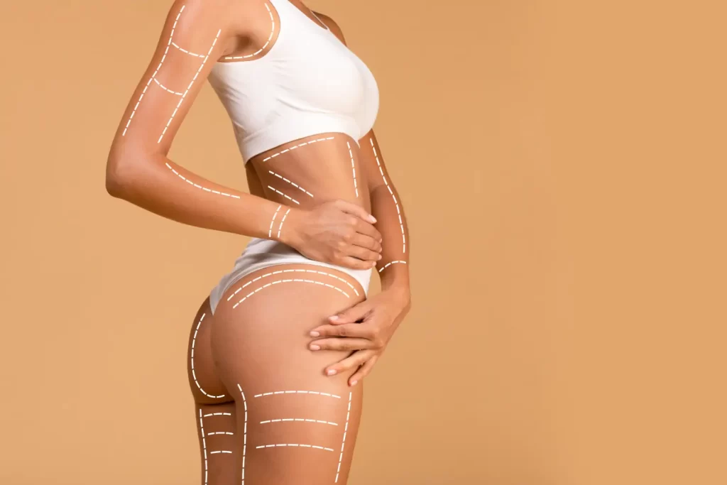 side view of woman's torso with dotted lines marking areas on arm, waist, and thigh