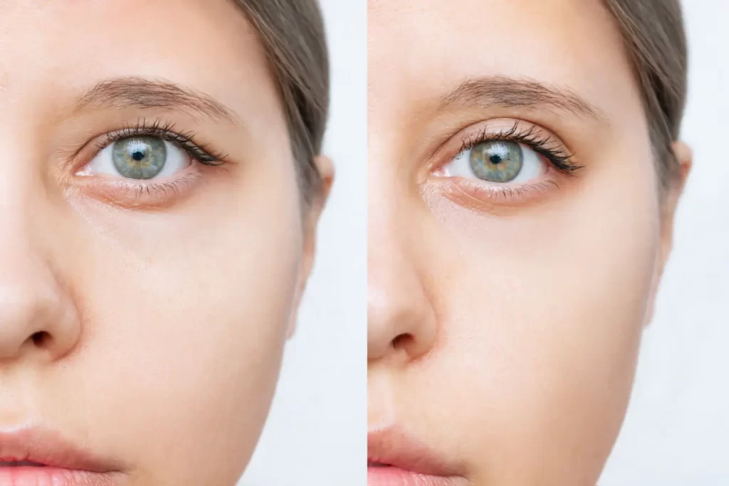 Side-by-side close-up of a person’s eye area showing differences in skin texture and brightness.