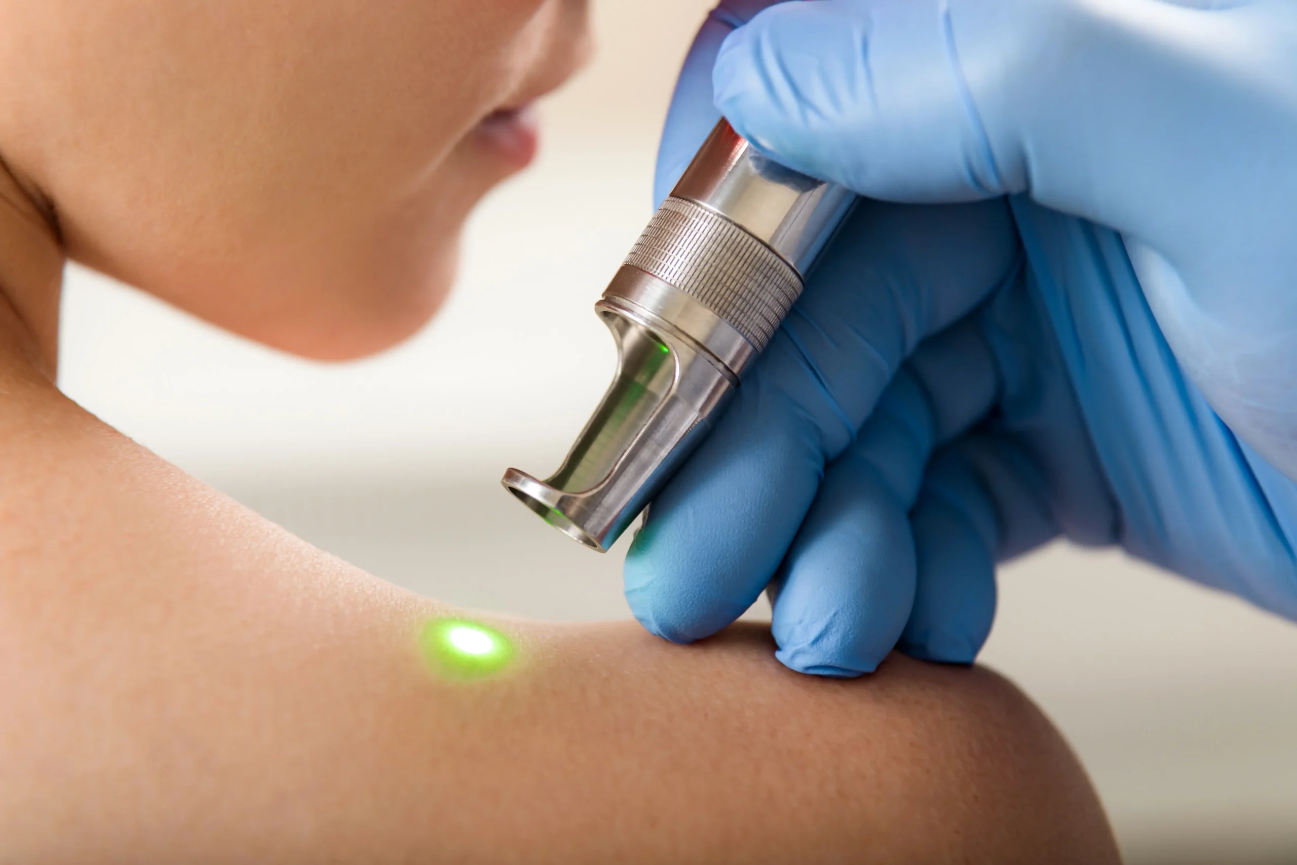 Laser device applied to skin on shoulder with green light 